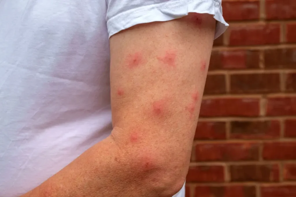 Spots of allergy.  