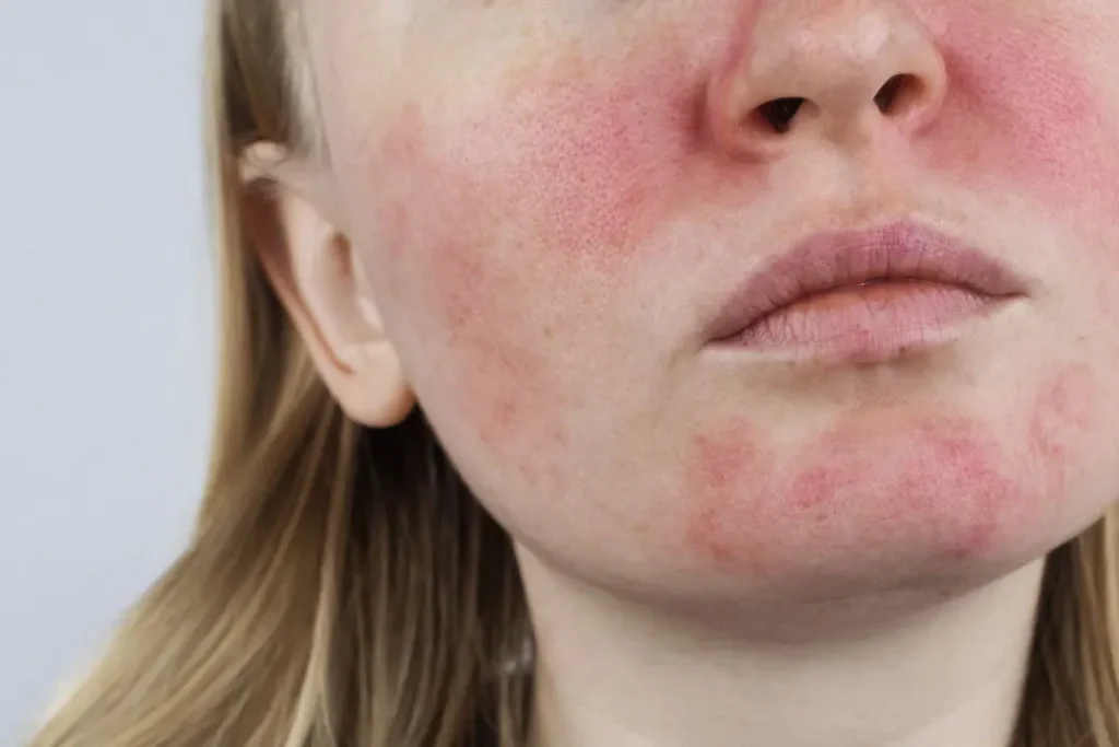 A woman having face allergy. 