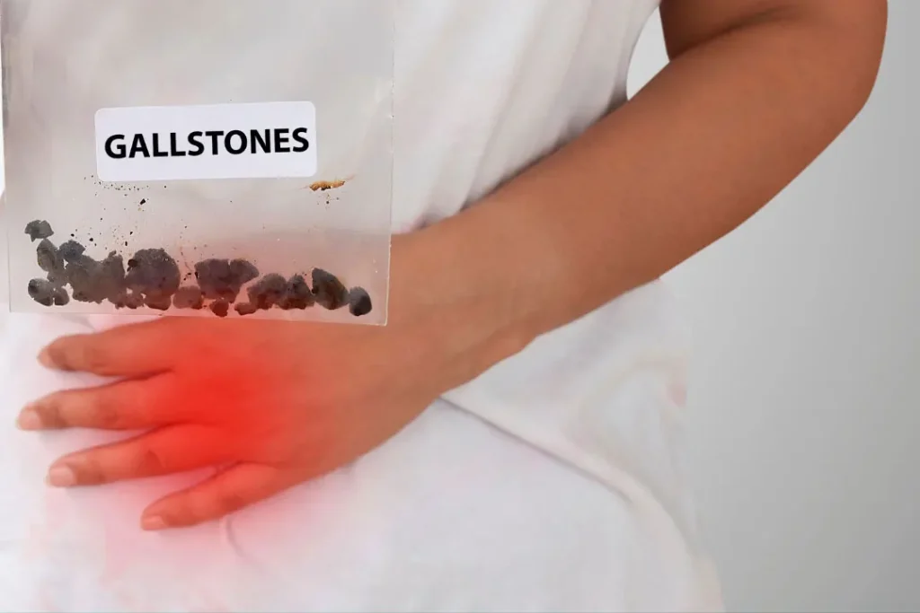 Gallstones. 