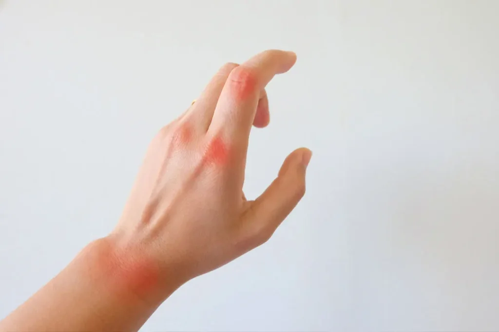 Fingers are affected by arthritis. 
