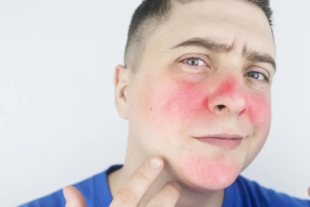 A man having allergy on his face. 
