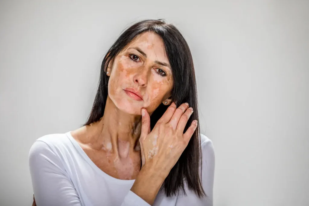 A lady having uneven skin. 