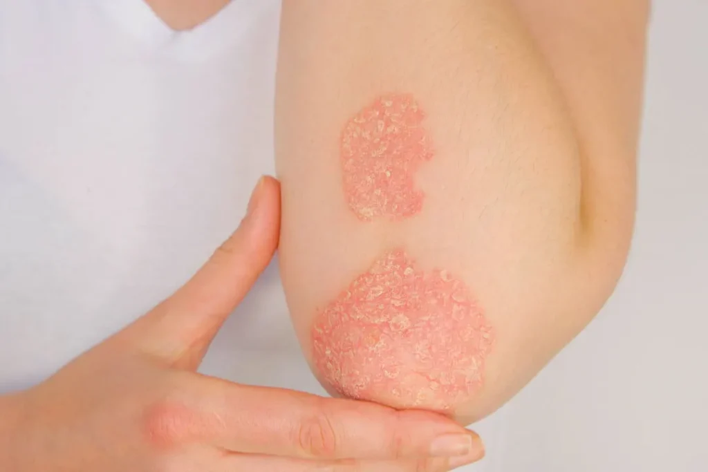 Skin allergy on arm. 