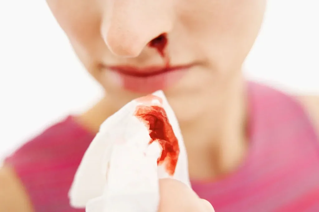 Bleeding nose. 