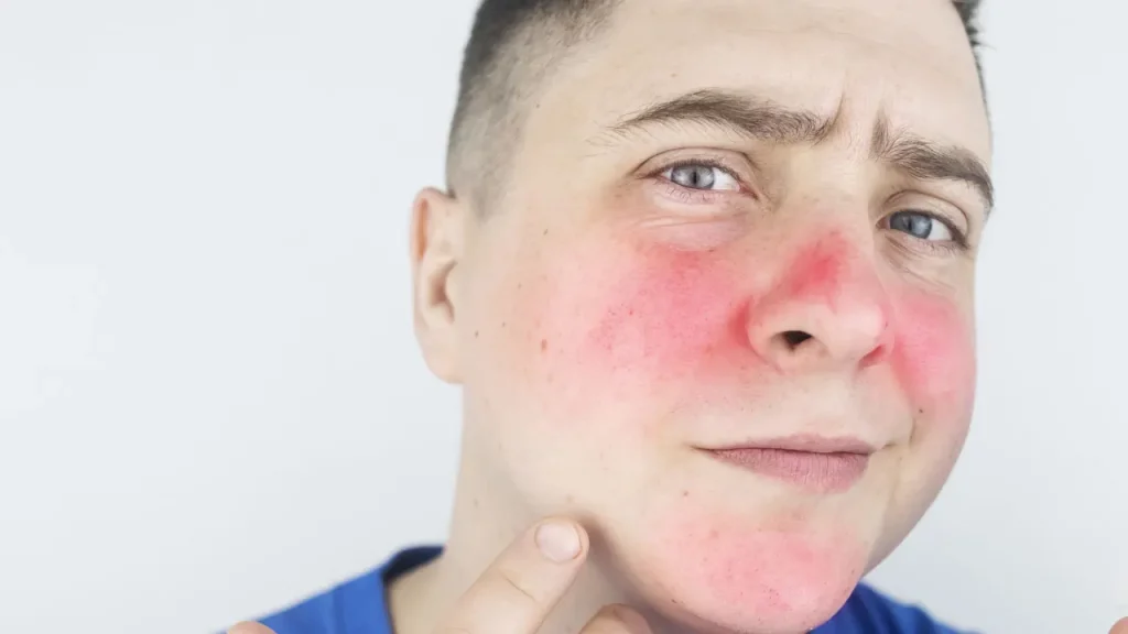 Man facing skin rashes on his face. 