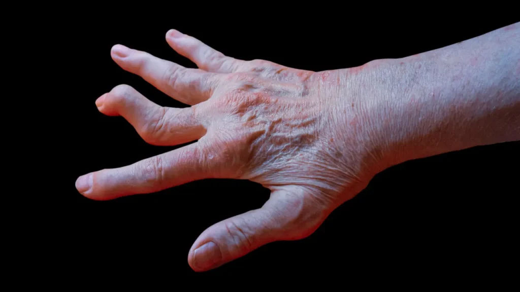 Rheumatoid arthritis issue. 