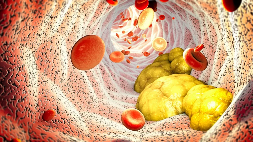 Cholesterol in blood vessel. 