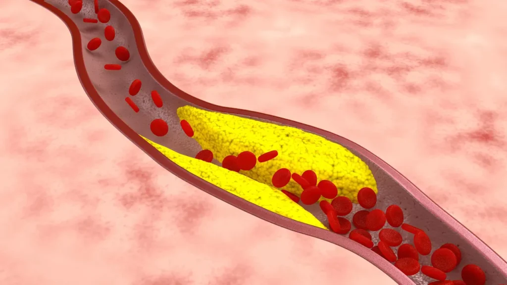Cholesterol level in blood vessel. 